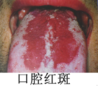 口腔均质性红斑图片图片